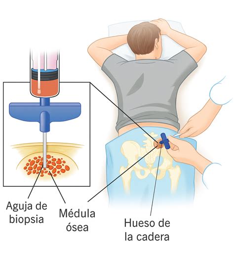 Diagrama anatómico mostrando el sitio de extracción de médula ósea en las crestas ilíacas