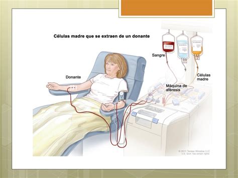 Ilustración de un separador celular utilizado en la aféresis para la donación de sangre periférica