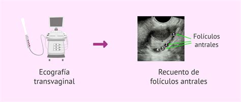 Infografía comparativa de las pruebas diagnósticas: perfil hormonal vs. ecografía de recuento folicular.