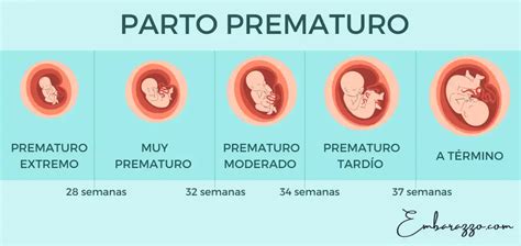 Gráfico que muestra la distribución de nacimientos prematuros por semanas de gestación, destacando el segmento del prematuro tardío.