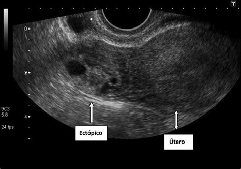 Imagen ecográfica transvaginal mostrando un saco gestacional fuera del útero, indicativo de embarazo ectópico.
