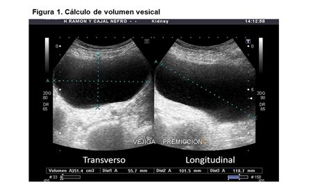 Diagrama que ilustra la diferencia entre la ecografía transabdominal y transvaginal, mostrando la posición de la sonda y la zona de visualización.