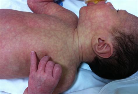 Bebé con patrón reticulado azulado en la piel, característico del cutis marmorata fisiológico en un entorno frío.