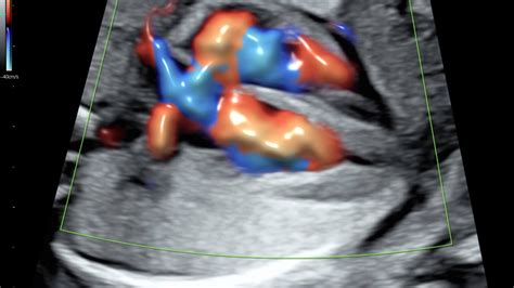 Imagen de un ecógrafo realizando una ecocardiografía fetal, mostrando la imagen del corazón del feto en la pantalla.