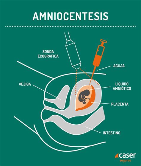 Ilustración de la amniocentesis y la toma de vellosidades coriónicas