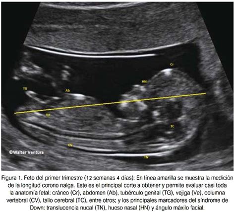 Ecografía fetal del primer trimestre con mediciones