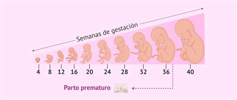Gráfico de incidencia de parto prematuro en gestaciones gemelares vs. únicas