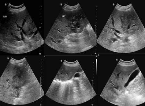 Imagen de ultrasonido abdominal mostrando una masa quística anecogénica en un neonato