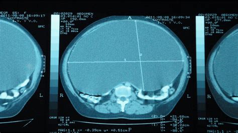 Fotografía quirúrgica de un quiste mesentérico extirpado del abdomen de un neonato