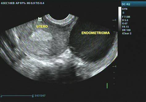 Ecografía transvaginal mostrando un endometrioma ovárico con características típicas de 