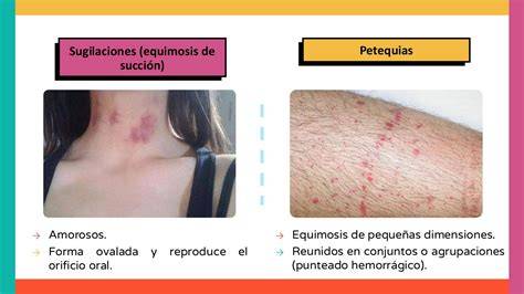 Esquema comparativo de petequias y púrpura