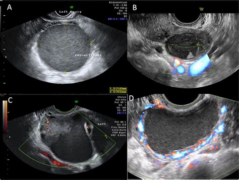 Esquema anatómico mostrando la formación de un endometrioma por invaginación de la corteza ovárica y su relación con estructuras pélvicas.