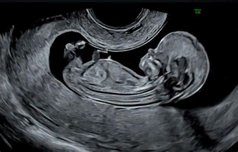 Imagen de una ecografía prenatal