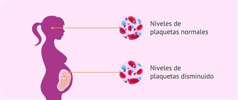 Esquema de la patogenia de la trombocitopenia neonatal aloinmune, mostrando la incompatibilidad de antígenos HPA entre la madre y el feto, la formación de anticuerpos maternos y la destrucción de plaquetas fetales.