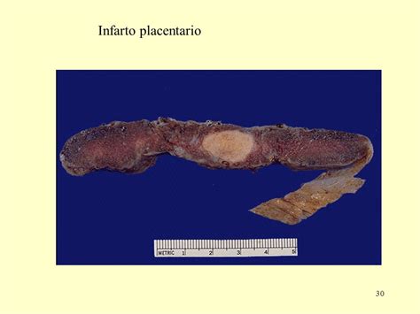 Microfotografía de infarto placentario