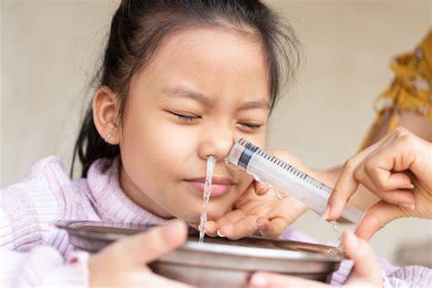 Foto de un niño recibiendo lavados nasales con suero fisiológico.