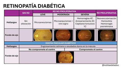 Diagrama de las fases de la retinopatía diabética con microaneurismas y nuevos vasos