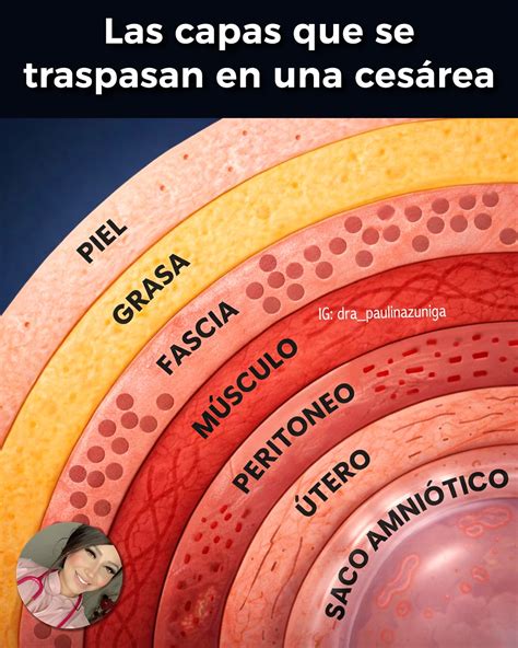 Esquema de las capas de una braga postparto con panel C-Section