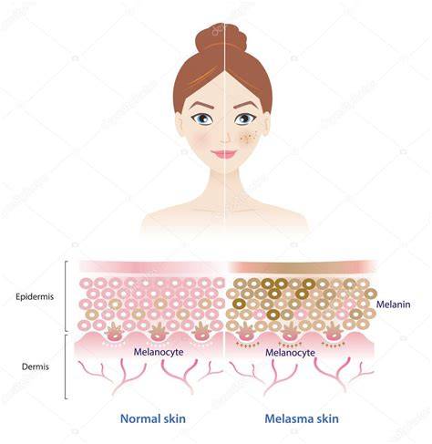 Diagrama de capas de la piel mostrando melasma epidérmico (superficial) y dérmico (profundo)