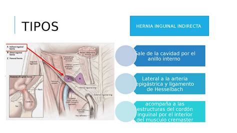 Diagrama anatómico de una hernia inguinal