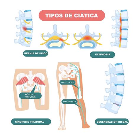 Esquema del nervio ciático y el útero durante el embarazo, mostrando la posible compresión