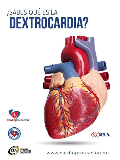 Ilustración médica del corazón humano con dextrocardia, mostrando su posición en el lado derecho del tórax.