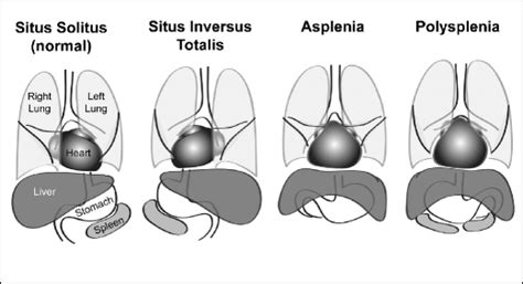 Diagrama comparativo del situs solitus (posición normal de órganos) y situs inversus (posición invertida de órganos).