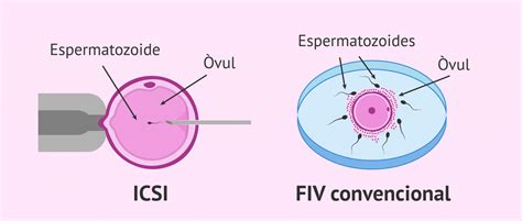 infografía comparando FIV convencional e ICSI