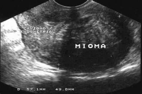 Ecografía transvaginal mostrando un mioma y un embrión