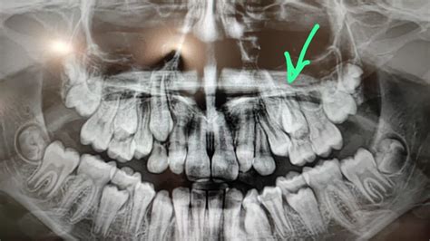 Radiografía dental mostrando la estructura de los dientes temporales y permanentes