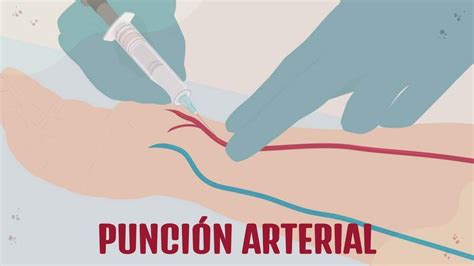 Ilustración 21: Esquema que ilustra la técnica de punción arterial en sentido dista-proximal.