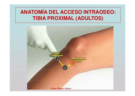 Ilustración 22: Localización anatómica para la punción intraósea en la tibia distal.