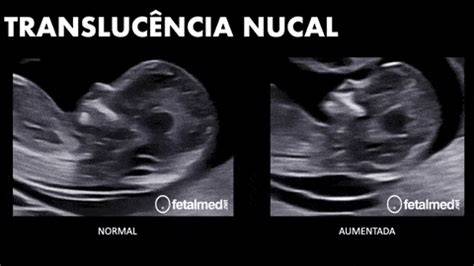 Esquema de medición de translucencia nucal en feto