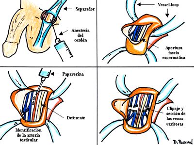 Varicocelectomía microquirúrgica