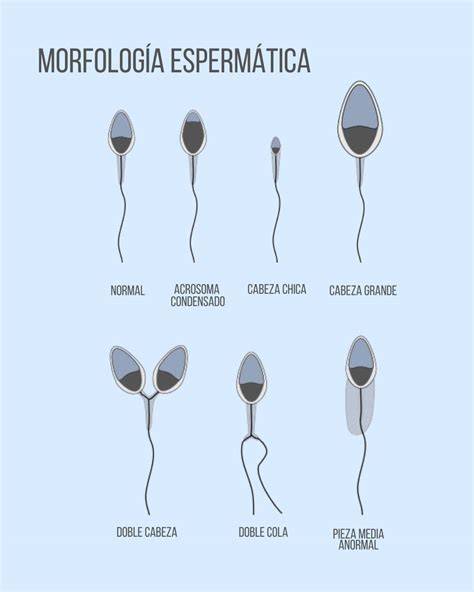 Infografía de espermatozoides con diferentes alteraciones morfológicas (cabeza, pieza intermedia, cola)