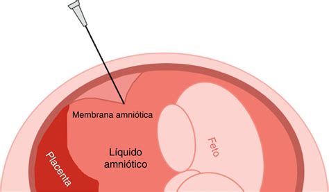 Diagrama del procedimiento de amniocentesis.