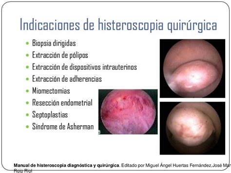 Imagen de histeroscopia mostrando la extracción de un pólipo uterino.