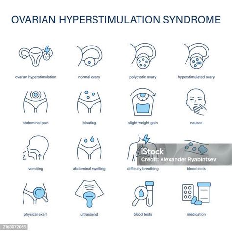 Ilustración de los síntomas comunes del Síndrome de Hiperestimulación Ovárica