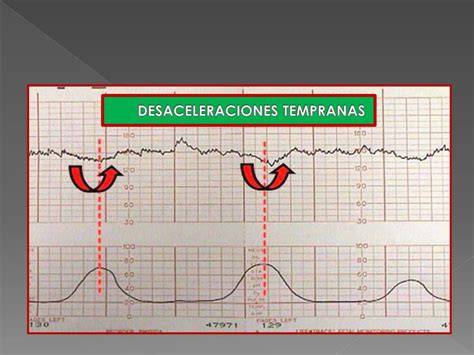 Esquema de desaceleración temprana mostrando el nadir alineado con el pico de la contracción