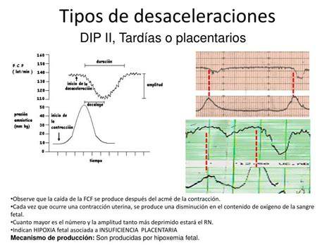 Esquema de desaceleración tardía mostrando el nadir posterior al pico de la contracción