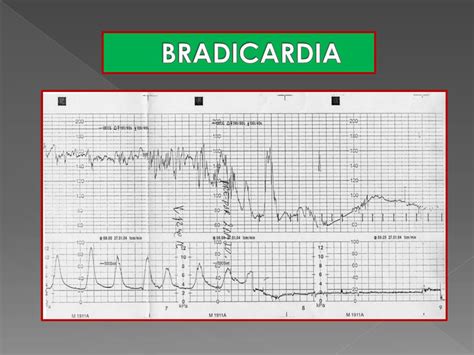 Trazado FCF de Categoría III con desaceleraciones tardías recurrentes o bradicardia