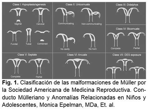 Esquema de los diferentes tipos de malformaciones müllerianas
