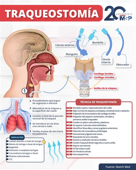 Infografía comparativa de la evolución histórica de la traqueostomía en pediatría