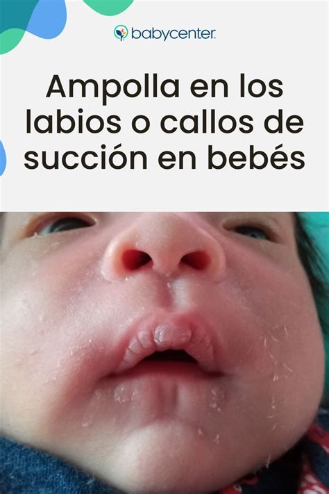 ampollas en los labios del bebé