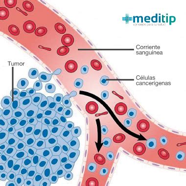 Representación esquemática de la diseminación de células cancerosas del colon a los ovarios.