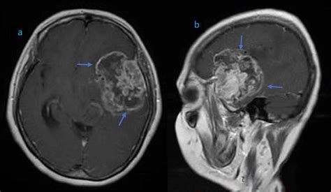 Imagen de resonancia magnética de un glioma de tronco cerebral