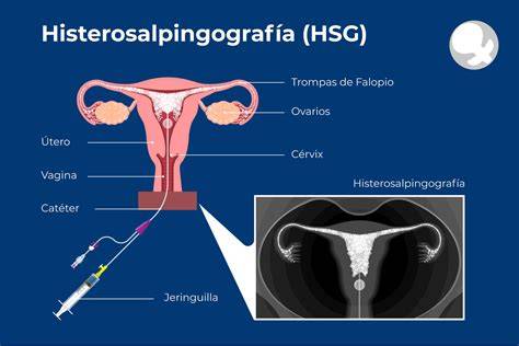 Diagrama de una histerosalpingografía mostrando el útero y las trompas