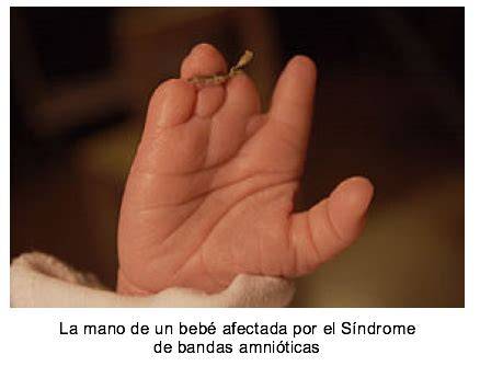 Ilustración del síndrome de bandas amnióticas afectando una extremidad fetal