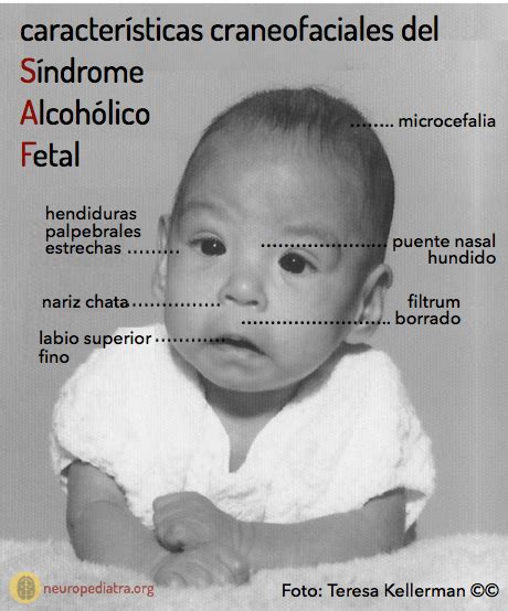 Infografía detallando las características físicas y neurológicas del Síndrome de Alcoholismo Fetal