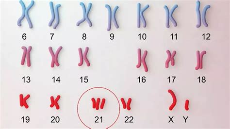 Ilustración de cromosomas humanos resaltando trisomías 13, 18, 21